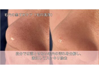 オーシャンブルー 時津店(OCEAN BLUE)/毛穴の黒ずみケア(毛穴洗浄)