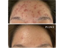 プランス 渋谷(PLANCE)/エステ　渋谷　おすすめ