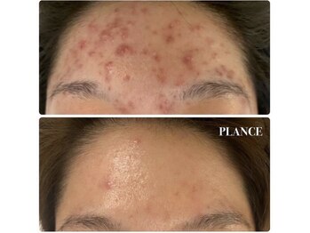 プランス 渋谷(PLANCE)/エステ 渋谷 おすすめ