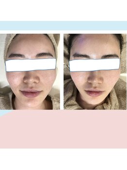 ロア ネイル アンド(loa nail and ...)/キュッと小顔