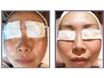 クエスト ビューティーサロン(QUEST)/光フェイシャル