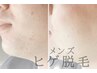 メンズヒゲ脱毛　▽ツルツルお肌へ