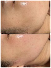 ソレラ(sorelle)/フェイシャルワックス