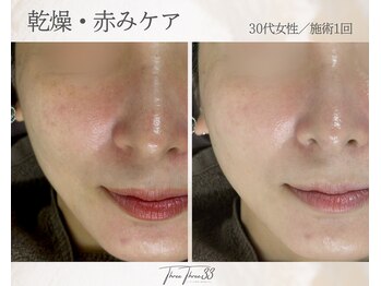 スリースリー(THREE THREE)/乾燥・赤みケア