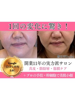 ホウレイ線・たるみ改善！予防ケア