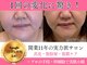 リライズ 磐田(Rerise)の写真/30.40代のフェイスライン緩み/二重顎なら専門店にお任せ!マスクいらず【美肌&小顔ハイパーカット¥12000~】