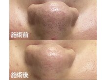 サロンリアンジュ ひたちなか店(Salon Liange)/毛穴洗浄◇ハイドロスキン◇