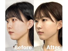 ラプリシュシュ 岡山店(Raplit)/ 隆鼻＋輪郭矯正40分10回