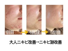 おうちサロン ミキ/ビフォーアフター/ニキビ・跡