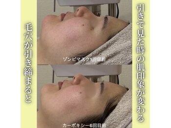 ハニエル(Haniel)/ゾンビマスク症例