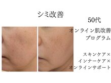 シャルナ(charna)/シミ改善プログラム