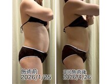 クールスパ(COOL SPA)/30代女性お腹症例