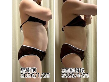 クールスパ(COOL SPA)/30代女性お腹症例