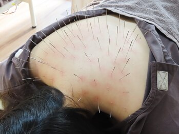 葵の葉鍼灸院の写真/刺激量は調整可能◎ 鍼が不安な方もリラックスして受けられます