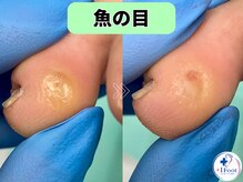 プラスワンフット 本厚木(+1 Foot)/小指の内側にできた魚の目