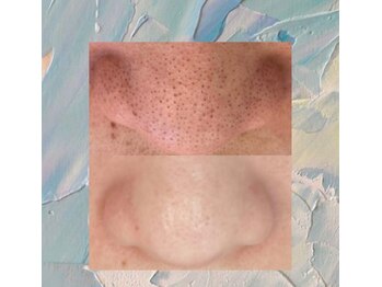 サロンド ユニバース(salon de universe)/鼻の黒ずみケア☆