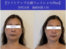 リプロ(RePro)/50代　ビフォーアフター