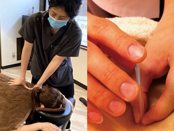 フォーゼ鍼灸整骨院の写真/首、肩こりや肩甲骨周りの頑固なコリの塊には鍼灸の刺激が効果大◎溶けるように柔らかくなる感覚を体験