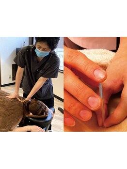 鍼灸施術を受けたい