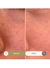 プラウド(Proud)/ケア症例/ハイドラケア