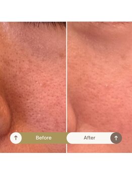 プラウド(Proud)/ケア症例/ハイドラケア