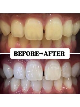 ホワイトニングサロン 豊中/Before&After美白ホワイトニング