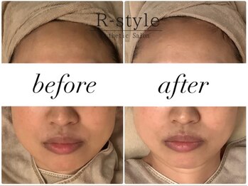 エステサロン アールスタイル(R-style)/テラボーラービフォア写真