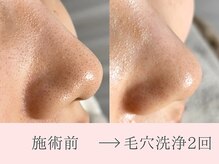 肌管理reimee レイミー【毛穴・シミケア】の雰囲気（【毛穴洗浄2回目】毛穴洗浄BeforeAfter 黒ずみがスッキリ綺麗に）