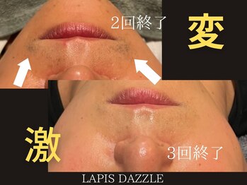 ラピスダズル(LAPIS DAZZLE)/ヒゲ脱毛☆途中経過