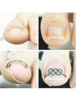 AZ美 整体院/巻き爪もおまかせください！