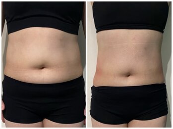 OBS新潟整骨院/脂肪冷却ビフォーアフター！