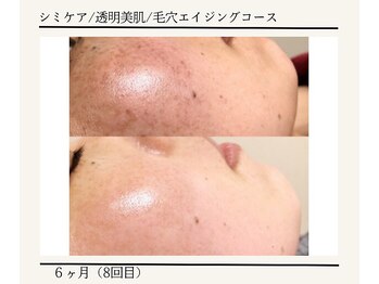 ルミエールフォートサイド(L’MIERE fortside)/お悩み:シミ,毛穴,くすみ