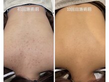 ライフサロン 別府(Life Salon)/背中ハーブトリートメント2