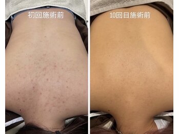 ライフサロン 別府(Life Salon)/背中ハーブトリートメント2