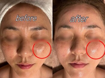 ブルーム(BLOOM)/REVI陶肌トリートメント