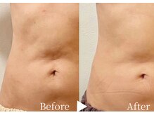 アリエルリッチ/【お腹】シルエットの変化＋ハリ