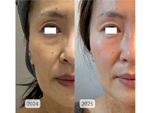 ミュアン(La Mueien)/40代目もとのたるみ・頬コケ