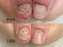 グレースレディ 大阪店/深爪/自爪育成/フィルイン