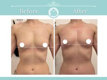 美人バスト大阪店/バストアップ◇症例◇