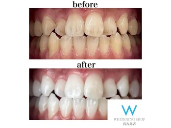 ホワイトニングショップ 宮古島店/短時間で圧倒的な効果
