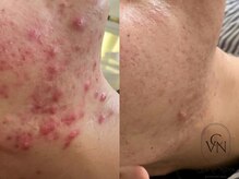 セルヴィノバ(CELL VI NOVA)/＊ビフォーアフター