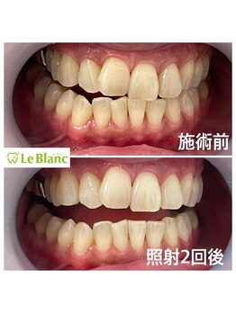 ルブラン 奈良店(Le Blanc)/歯のケアしましょう!!