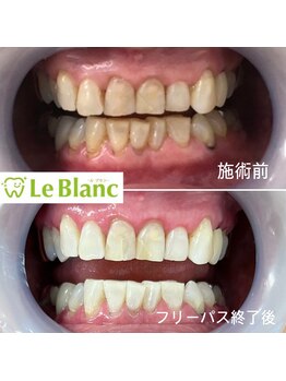 ルブラン 奈良店(Le Blanc)/本来の歯のお色へ!
