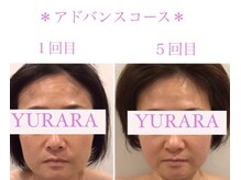 ユララ(YURARA)/～美容鍼～驚きの効果♪