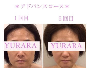 ユララ(YURARA)/～美容鍼～驚きの効果♪