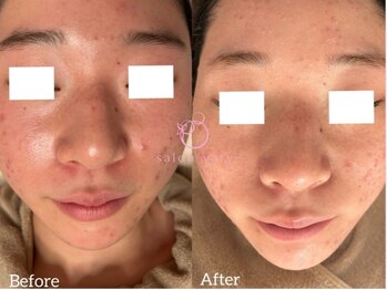 サロンヴェアリー 広尾(salon vary)/花粉荒れ赤み鎮静#水玉#白玉