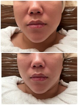 ナナプラス(nana plus)/フェイスラインスッキリ