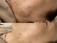 ヴェアリー 広尾(VARY)の雰囲気(毛穴やニキビケアだけでなく、諦めていたあと残りも綺麗に。)