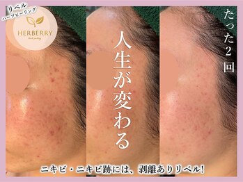 アッシュ 梅田(H)/ハーブピーリング専門Hアッシュ