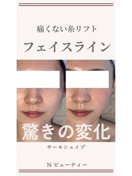 Nビューティー/最新RFサーモシェイプオーパス